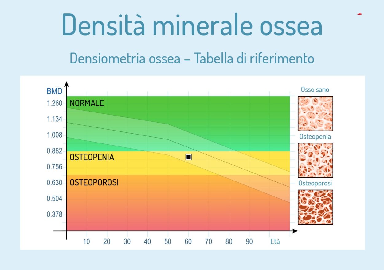Test Prevenzione Osteoporosi