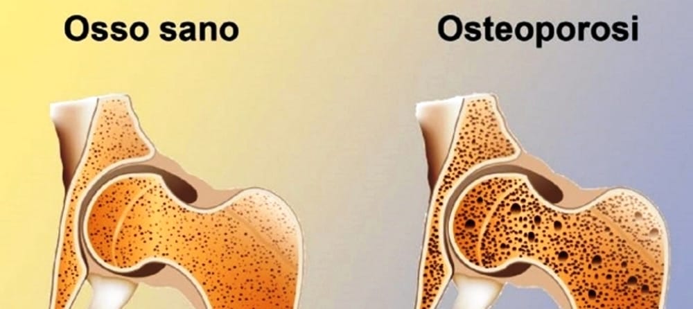 Test Prevenzione Osteoporosi